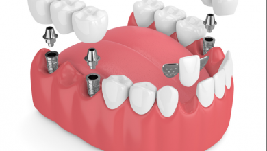 Dental Implant Bridges