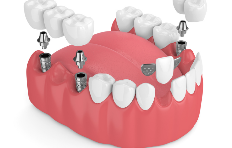 Dental Implant Bridges