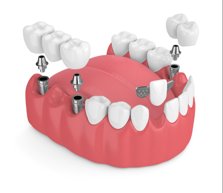 Dental Implant Bridges