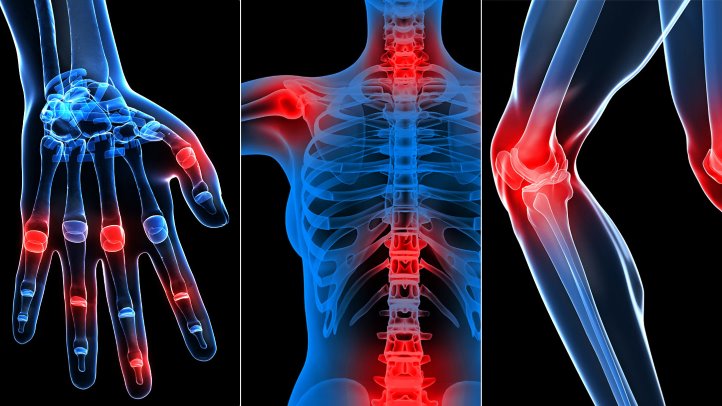 Rheumatoid Arthritis