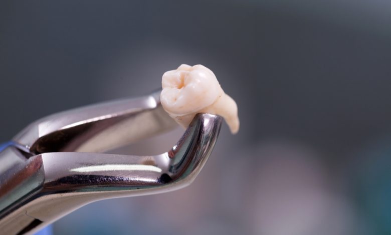 tooth extraction