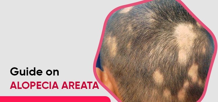 Guide on Alopecia Areata