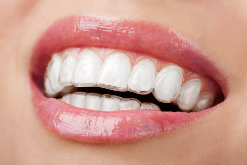 invisalign cost london