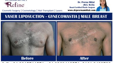 Gynecomastia in ludhiana