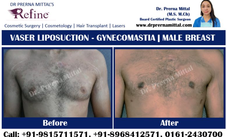 Gynecomastia in ludhiana