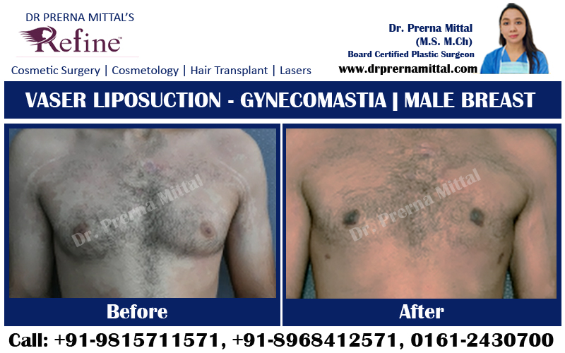 Gynecomastia in ludhiana