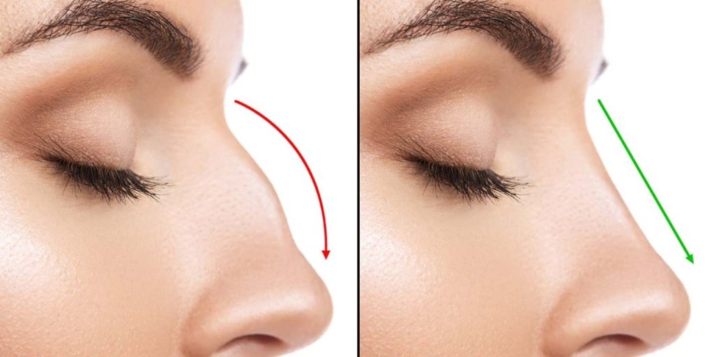 rhinoplasty cost in Haryana