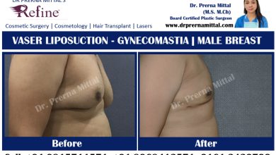 Gynecomastia in Ludhiana