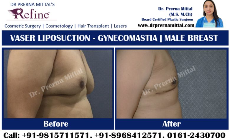 Gynecomastia in Ludhiana