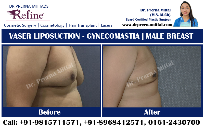 Gynecomastia in Ludhiana