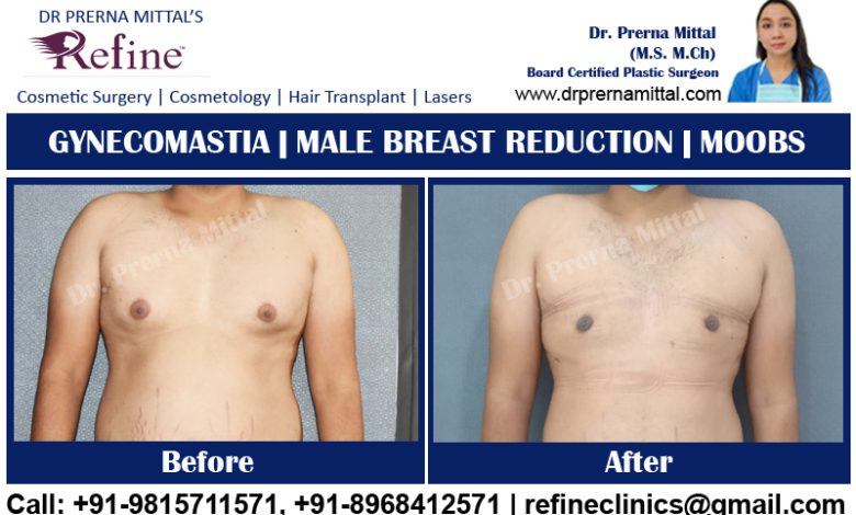 Gynecomastia in ludhiana