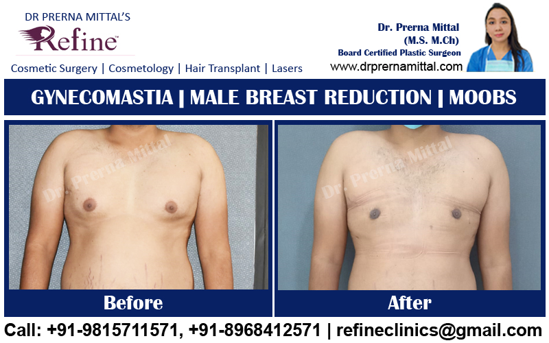 Gynecomastia in ludhiana