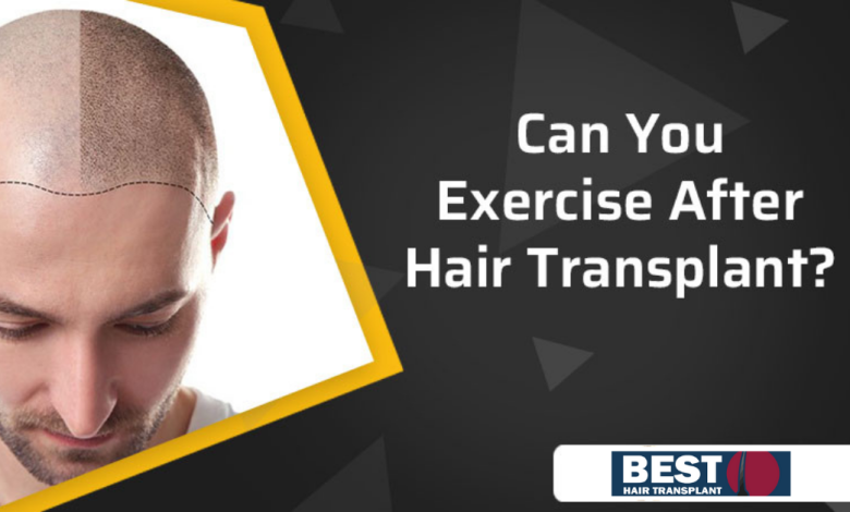 can-you-exercise-after-hair-transplant