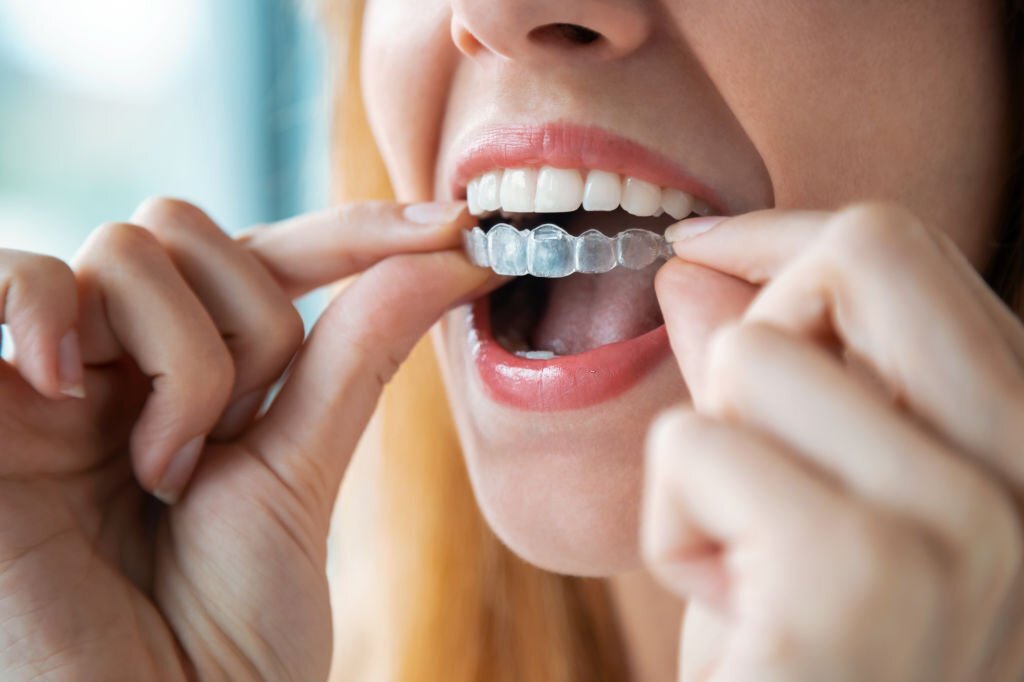 Importance Of Retainers After Invisalign And Braces