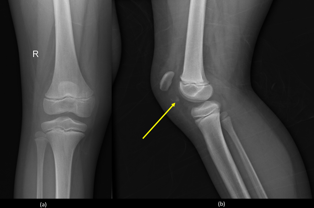 What-are-the-causes-of-knee-fracture