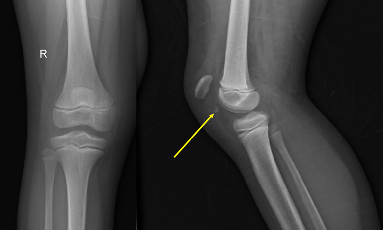 What-are-the-causes-of-knee-fracture