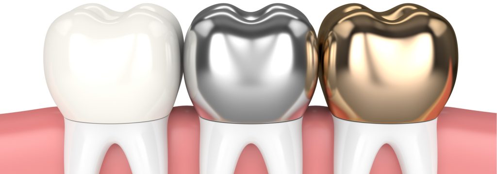 stainless steel dental crowns